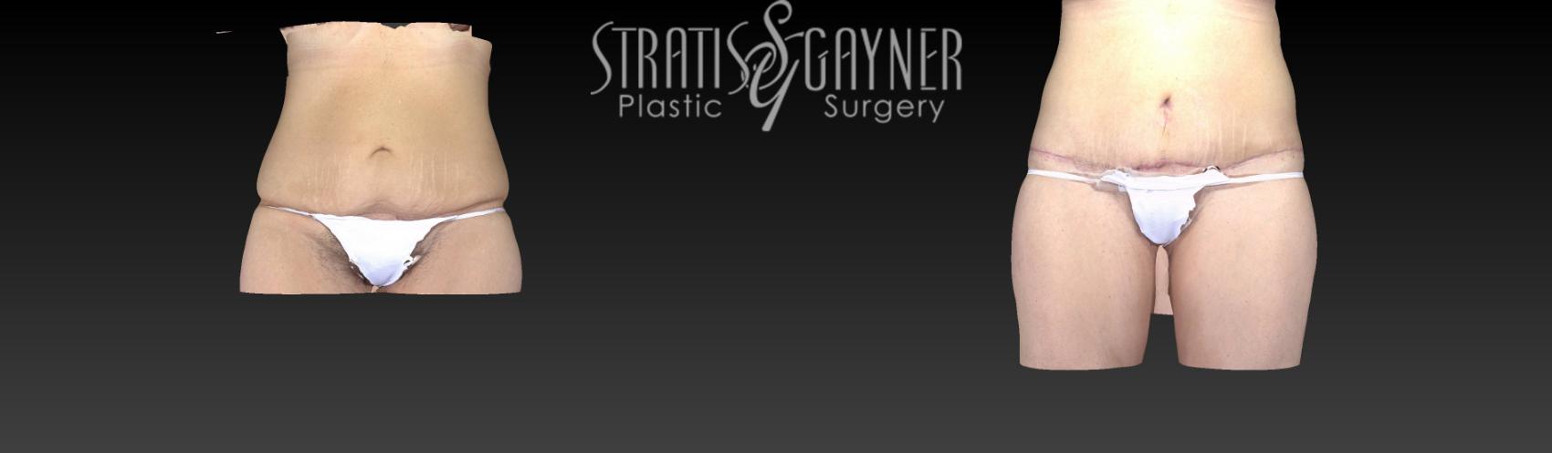 Body Lift Case 159 Before & After View #1 | Harrisburg, PA | Stratis Gayner Plastic Surgery