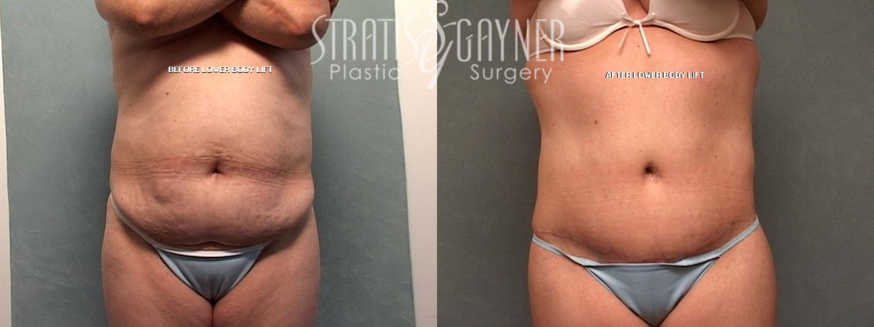 Body Lift Case 78 Before & After View #1 | Harrisburg, PA | Stratis Gayner Plastic Surgery