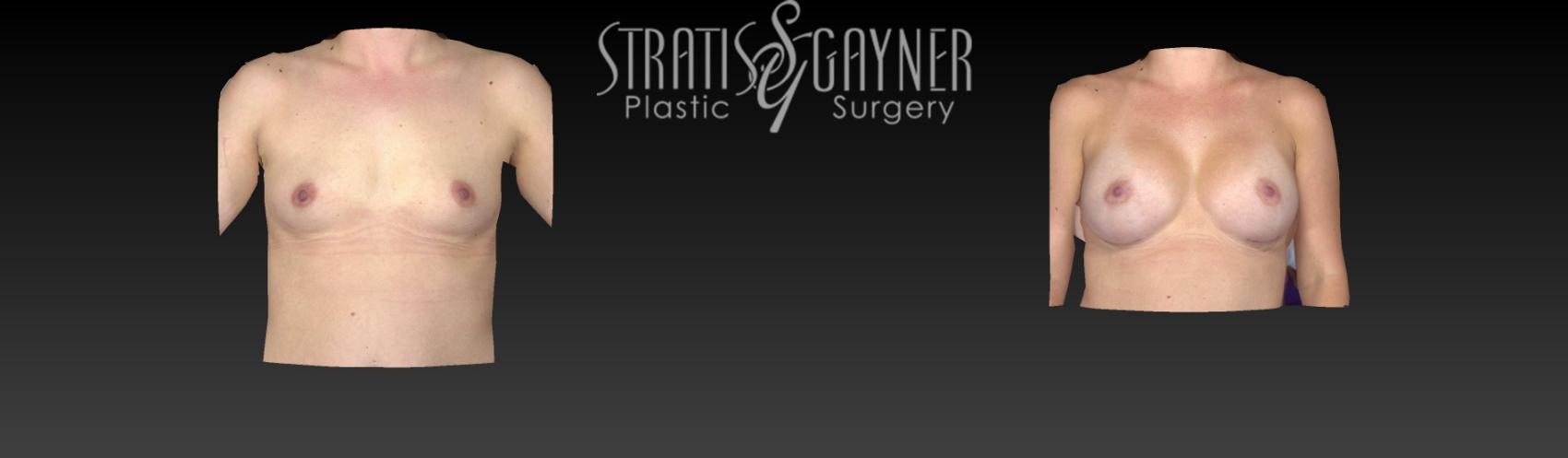 Breast Augmentation Case 90 Before & After View #1 | Harrisburg, PA | Stratis Gayner Plastic Surgery
