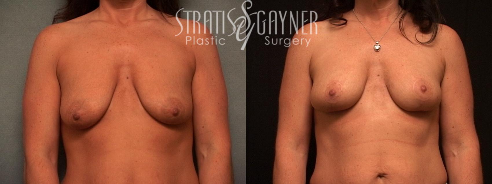 Breast Augmentation with Lift Case 100 Before & After View #1 | Harrisburg, PA | Stratis Gayner Plastic Surgery