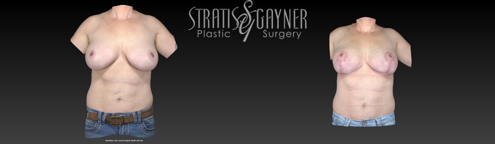 Breast Augmentation with Lift Case 103 Before & After View #1 | Harrisburg, PA | Stratis Gayner Plastic Surgery