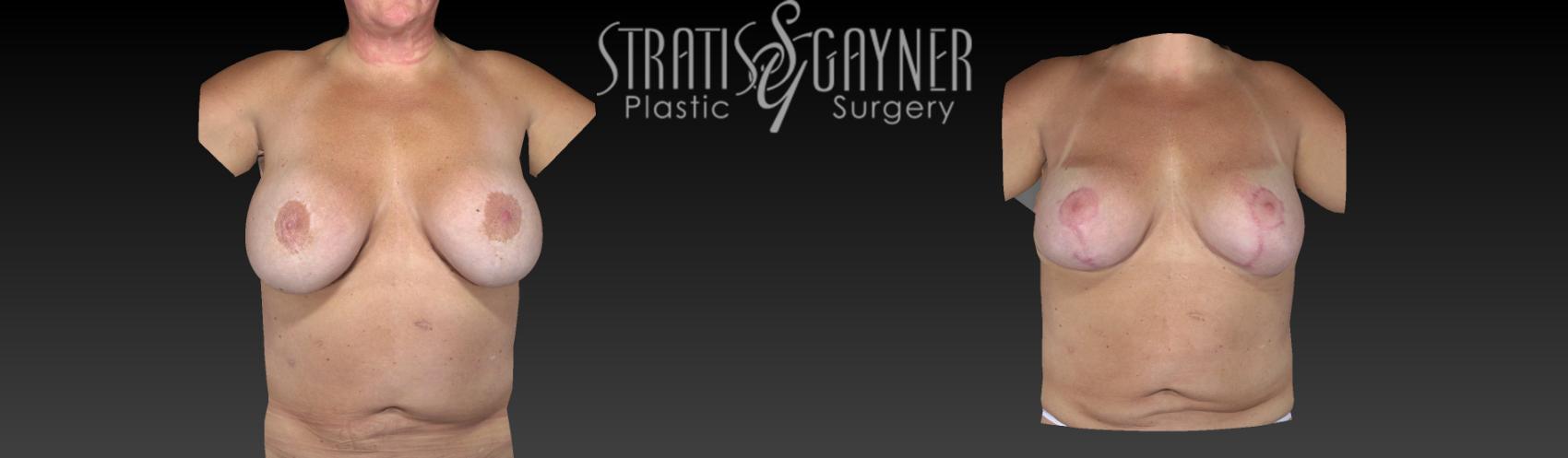 Breast Augmentation with Lift Case 109 Before & After View #1 | Harrisburg, PA | Stratis Gayner Plastic Surgery