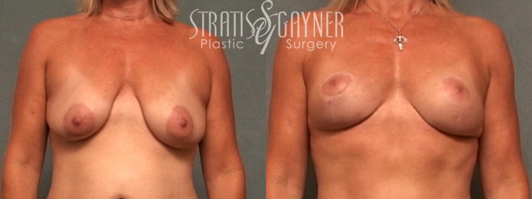 Breast Lift Case 50 Before & After View #1 | Harrisburg, PA | Stratis Gayner Plastic Surgery