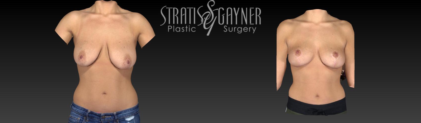 Breast Lift Case 57 Before & After View #1 | Harrisburg, PA | Stratis Gayner Plastic Surgery