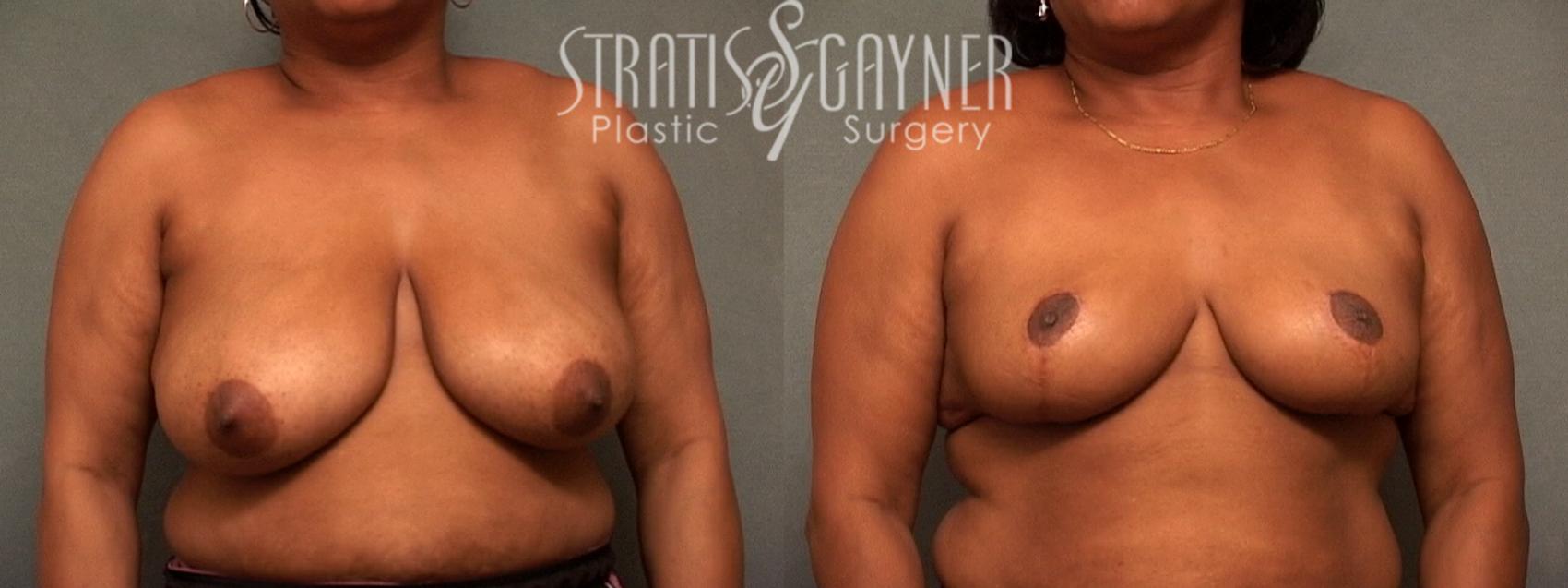 Breast Reduction Case 110 Before & After View #1 | Harrisburg, PA | Stratis Gayner Plastic Surgery