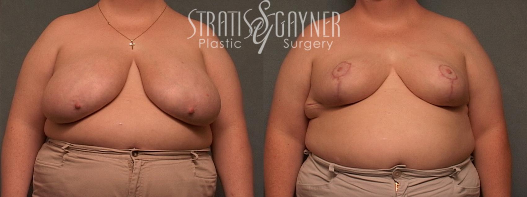 Breast Reduction Case 112 Before & After View #1 | Harrisburg, PA | Stratis Gayner Plastic Surgery