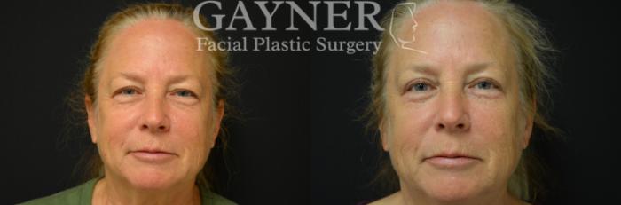 Before & After Eyelid Surgery Case 228 Front View in Harrisburg, PA