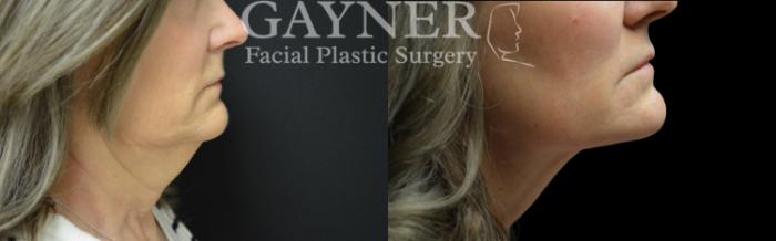Before & After Facial Liposuction Case 229 Right Side View in Harrisburg, PA