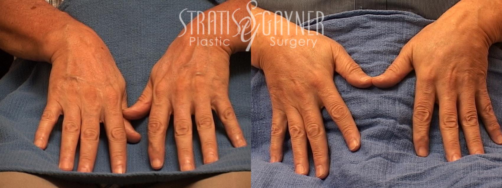 Fat Transfer to Hands Case 171 Before & After View #1 | Harrisburg, PA | Stratis Gayner Plastic Surgery