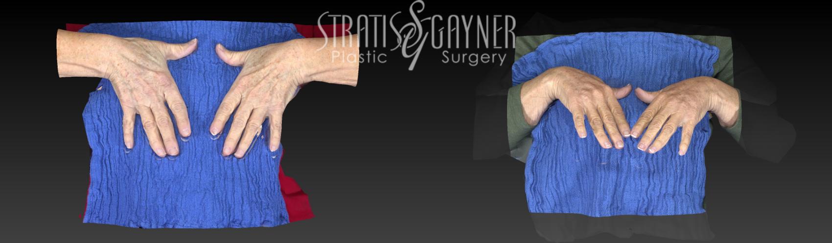 Fat Transfer to Hands Case 172 Before & After View #1 | Harrisburg, PA | Stratis Gayner Plastic Surgery