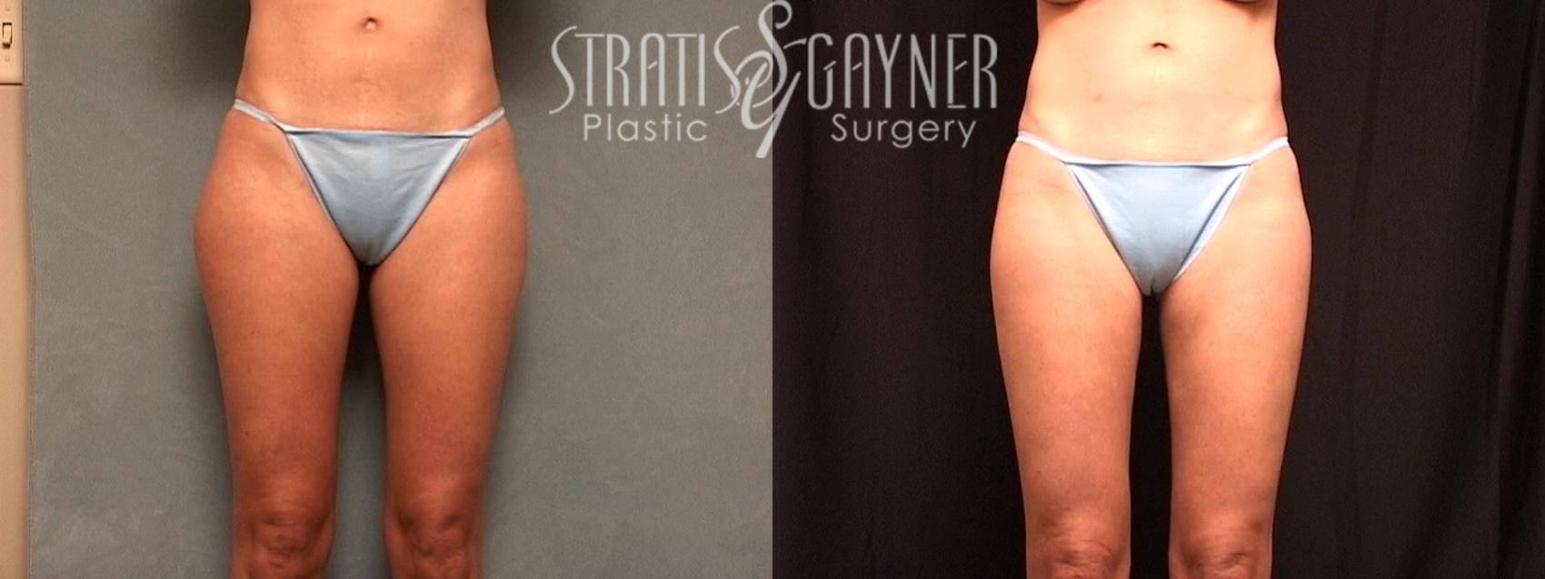 Liposuction Case 123 Before & After View #1 | Harrisburg, PA | Stratis Gayner Plastic Surgery