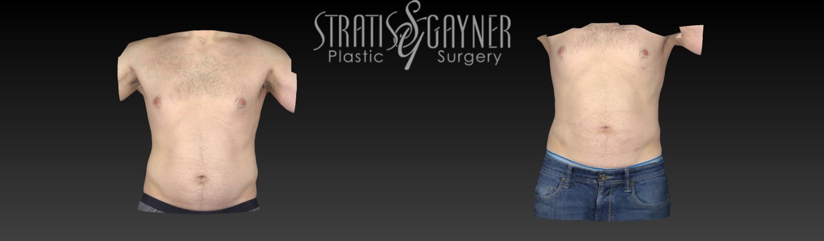 Liposuction Case 124 Before & After View #1 | Harrisburg, PA | Stratis Gayner Plastic Surgery