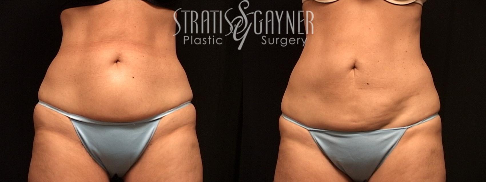 Liposuction Case 129 Before & After View #1 | Harrisburg, PA | Stratis Gayner Plastic Surgery