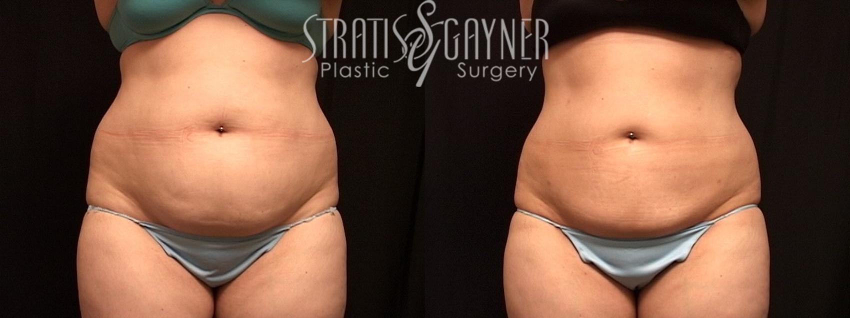 Liposuction Case 27 Before & After View #1 | Harrisburg, PA | Stratis Gayner Plastic Surgery