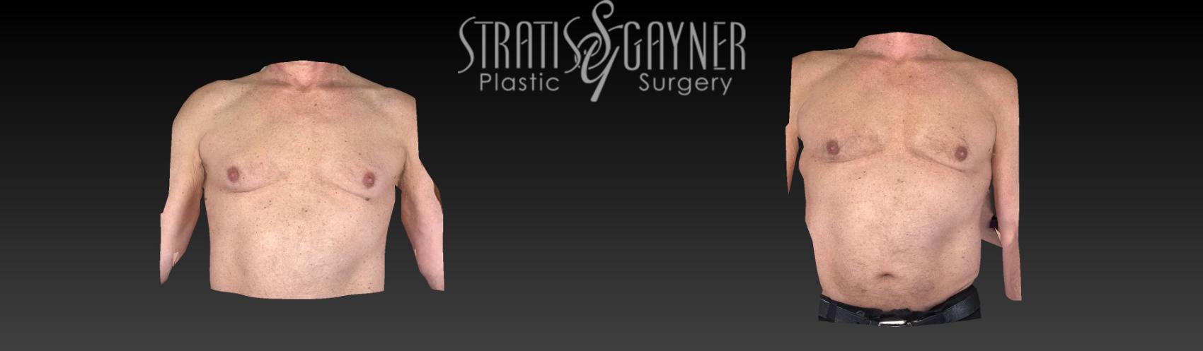 Before & After Male Breast Reduction Case 176 View #1 View in Harrisburg, PA