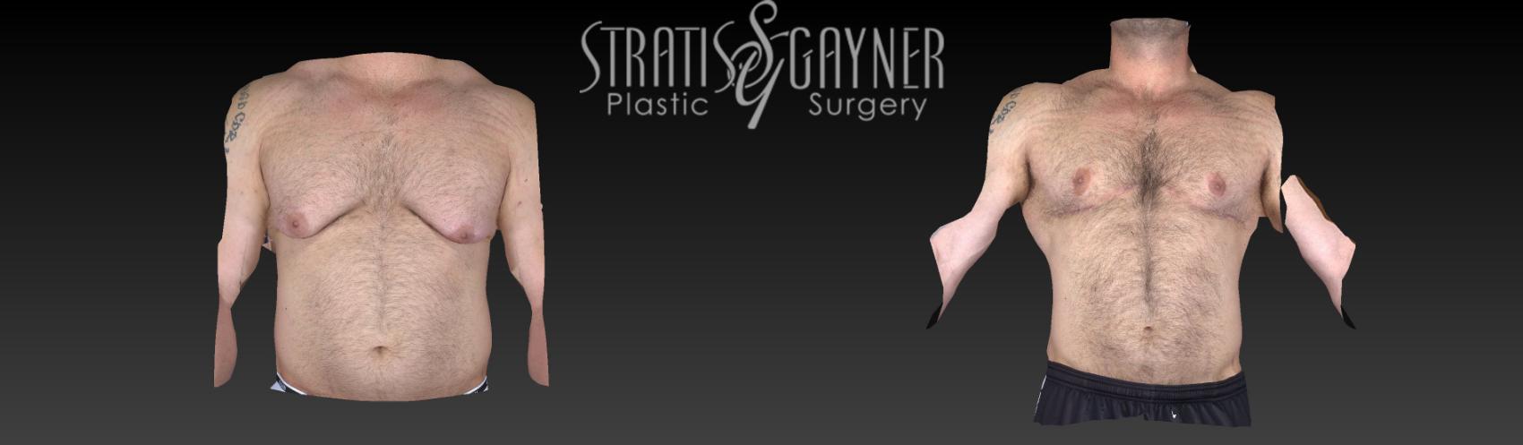 Before & After Male Breast Reduction Case 178 View #1 View in Harrisburg, PA