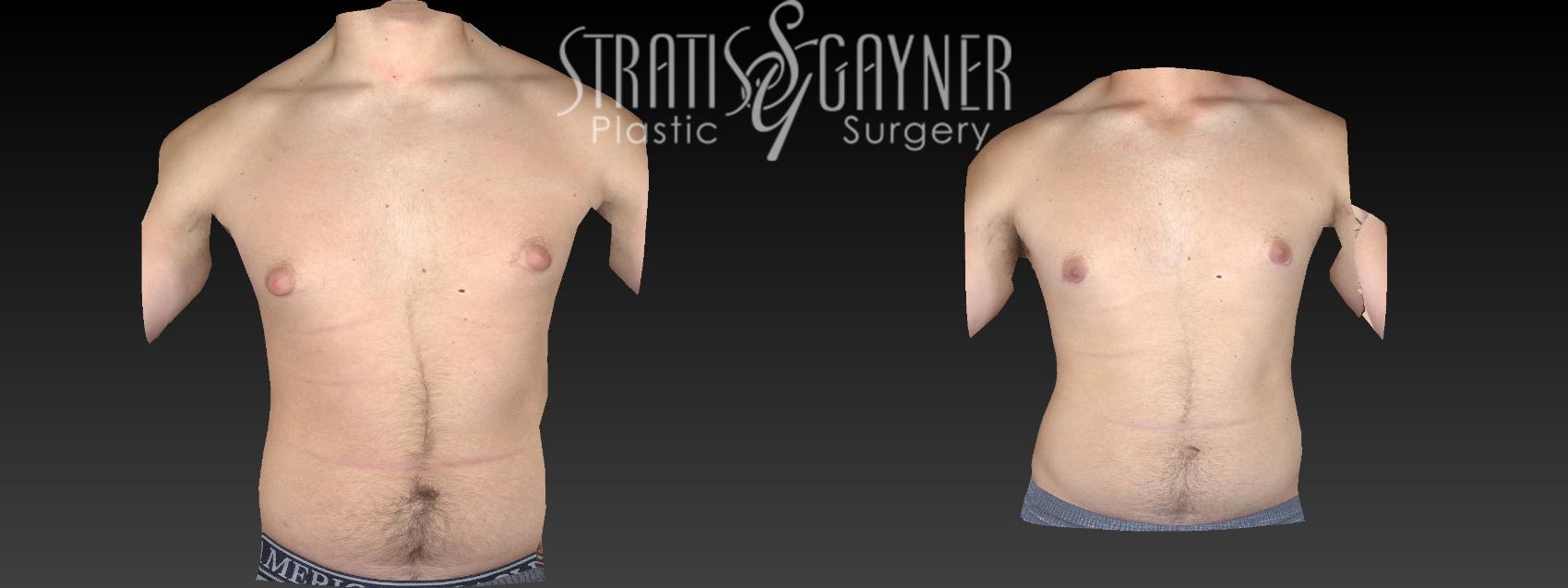 Before & After Male Breast Reduction Case 46 View #1 View in Harrisburg, PA