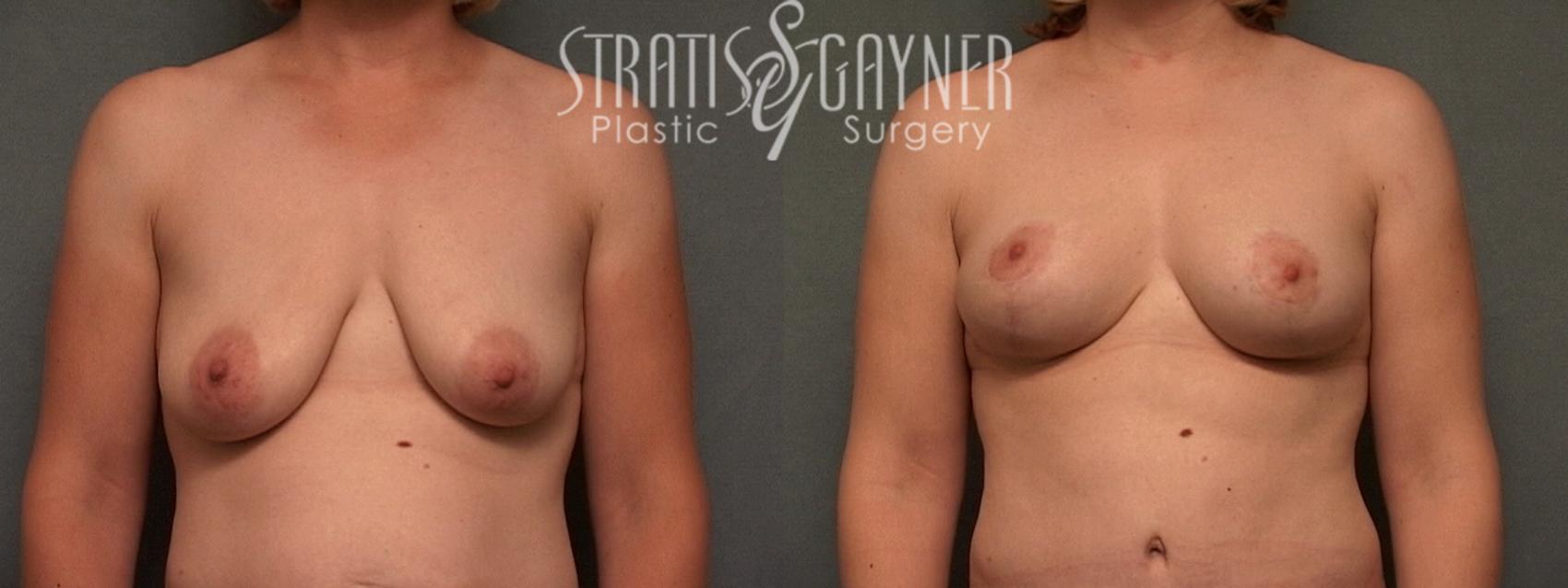Mommy Makeover Case 52 Before & After View #1 | Harrisburg, PA | Stratis Gayner Plastic Surgery