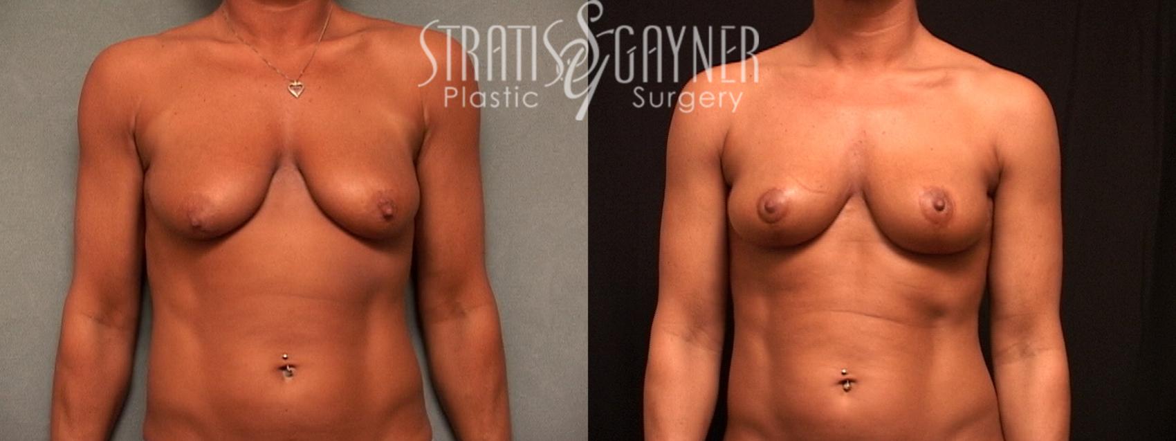 Mommy Makeover Case 54 Before & After View #1 | Harrisburg, PA | Stratis Gayner Plastic Surgery
