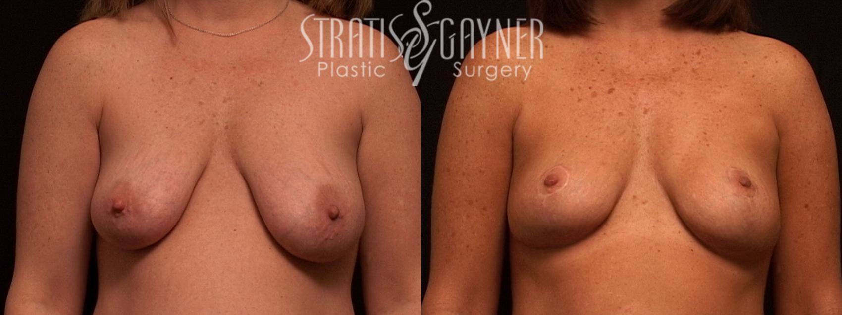 Mommy Makeover Case 55 Before & After View #1 | Harrisburg, PA | Stratis Gayner Plastic Surgery