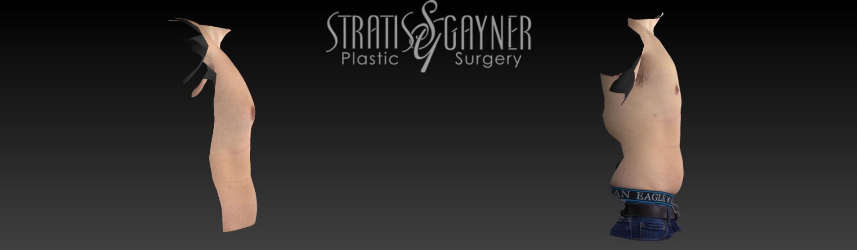 Before & After Male Breast Reduction Case 218 Front View in Harrisburg, PA