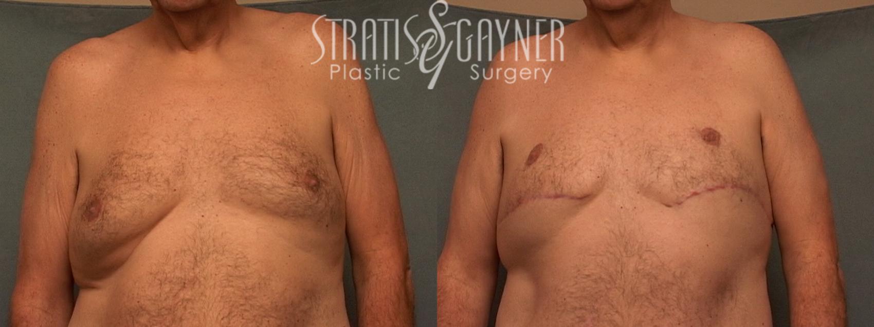 Before & After Male Breast Reduction Case 59 View #1 View in Harrisburg, PA