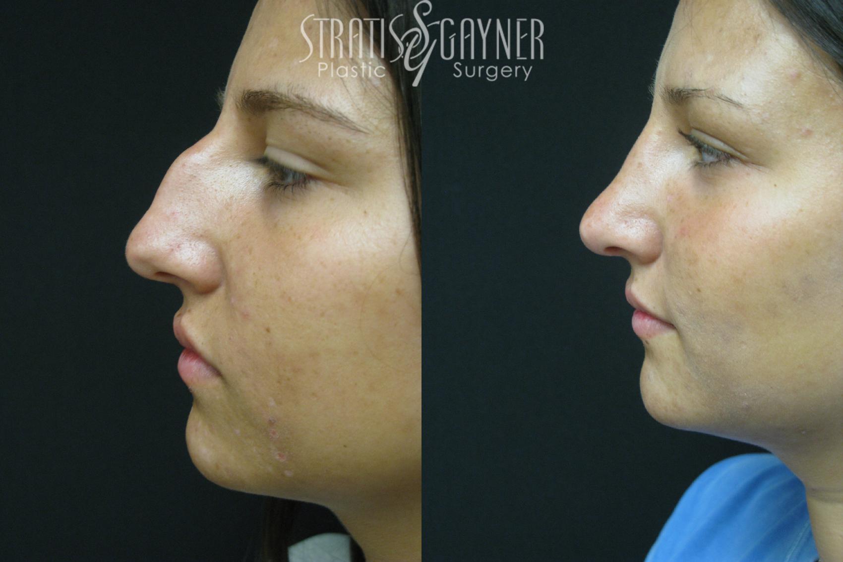 Before & After Rhinoplasty Case 226 Left Side View in Harrisburg, PA