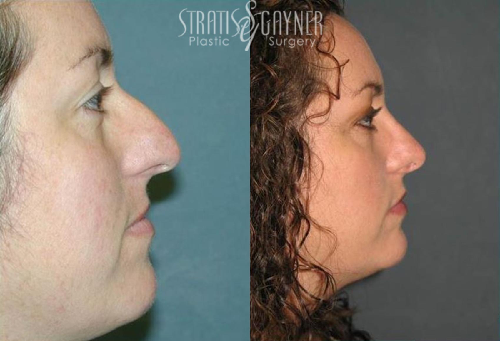 Before & After Rhinoplasty Case 72 View #1 View in Harrisburg, PA