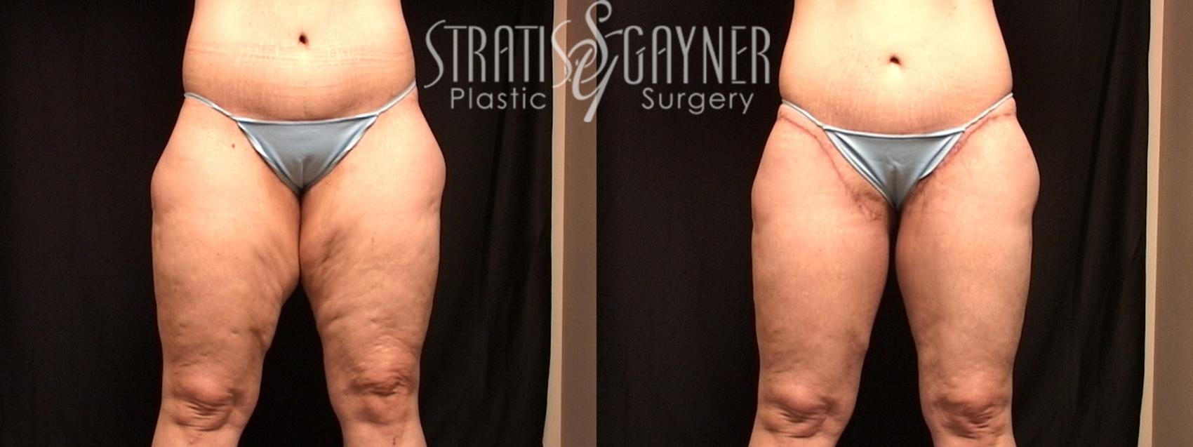 Thigh Lift Case 132 Before & After View #1 | Harrisburg, PA | Stratis Gayner Plastic Surgery