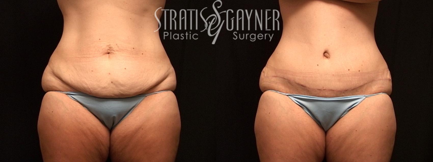 Tummy Tuck Case 150 Before & After View #1 | Harrisburg, PA | Stratis Gayner Plastic Surgery