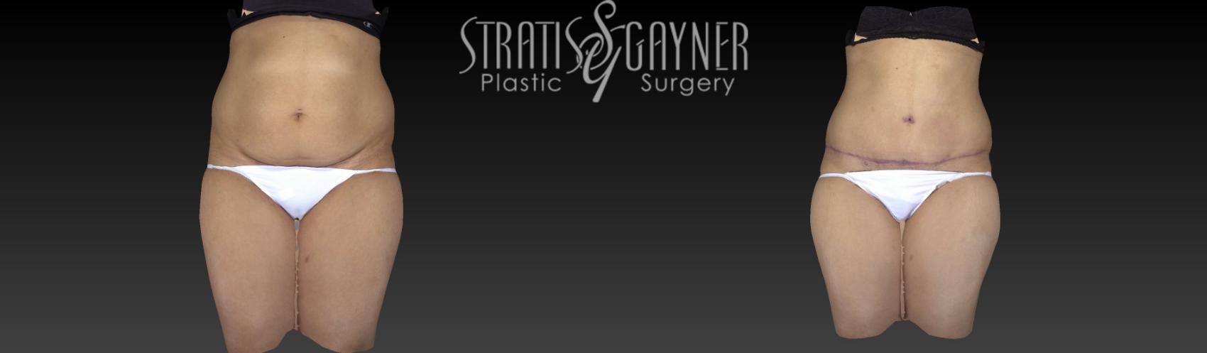 Before & After Tummy Tuck Case 196 View #1 View in Harrisburg, PA