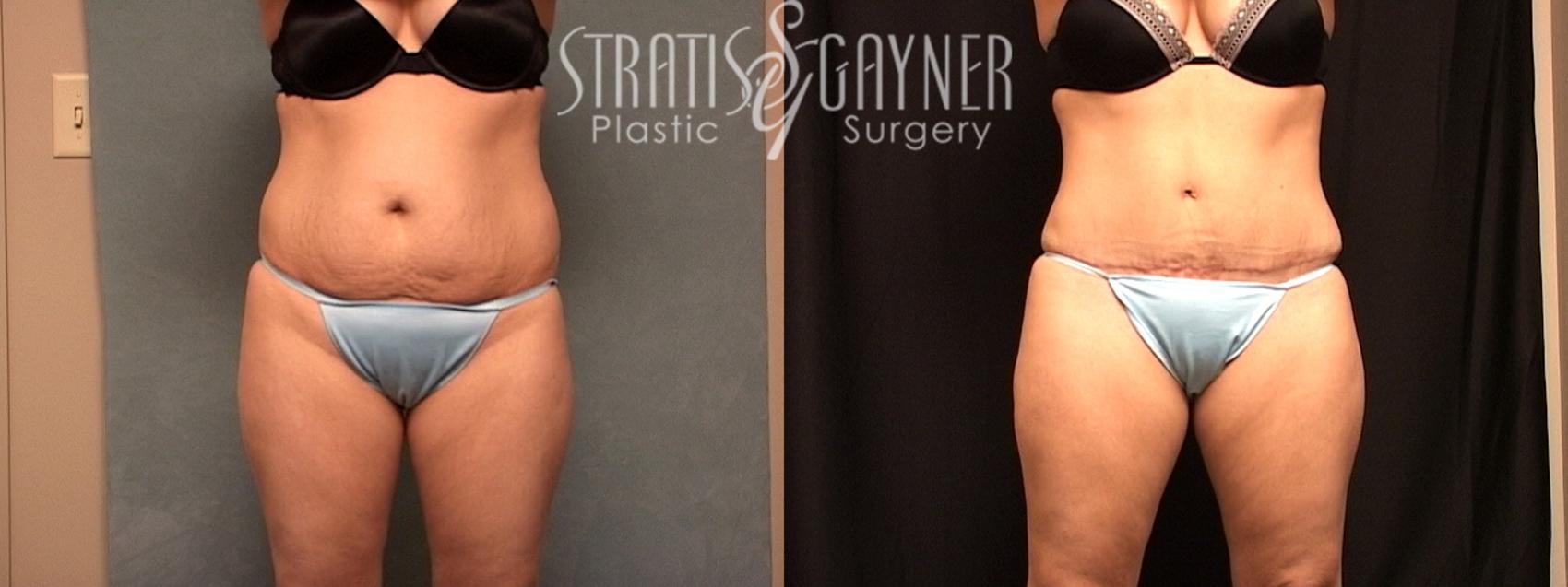 Tummy Tuck with Liposuction Case 153 Before & After View #1 | Harrisburg, PA | Stratis Gayner Plastic Surgery