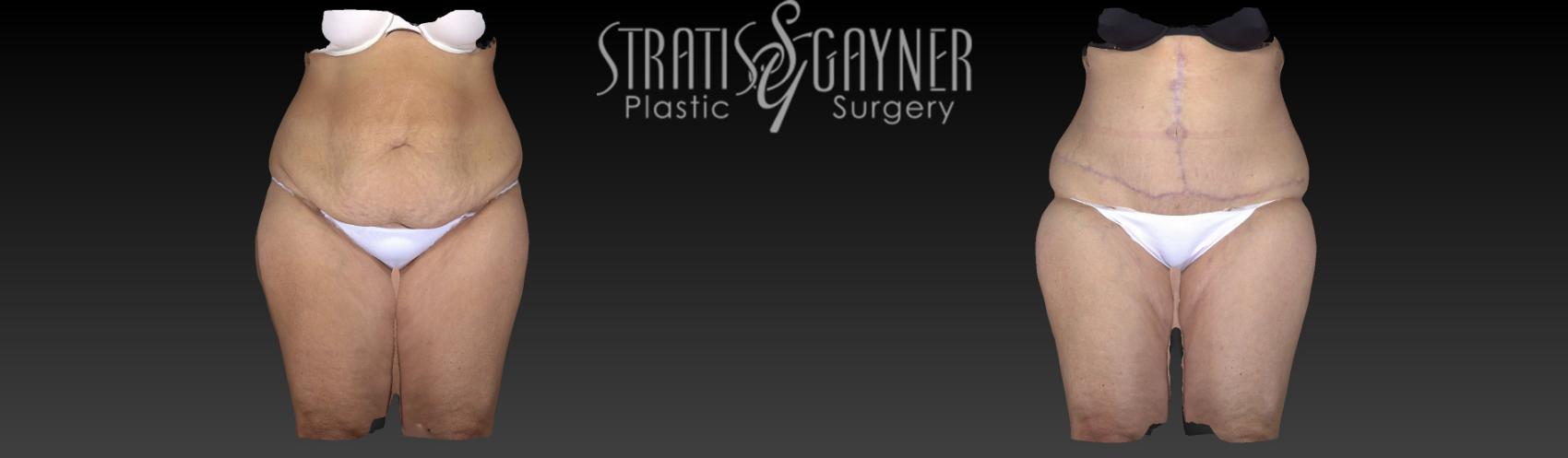 Tummy Tuck with Liposuction Case 154 Before & After View #1 | Harrisburg, PA | Stratis Gayner Plastic Surgery