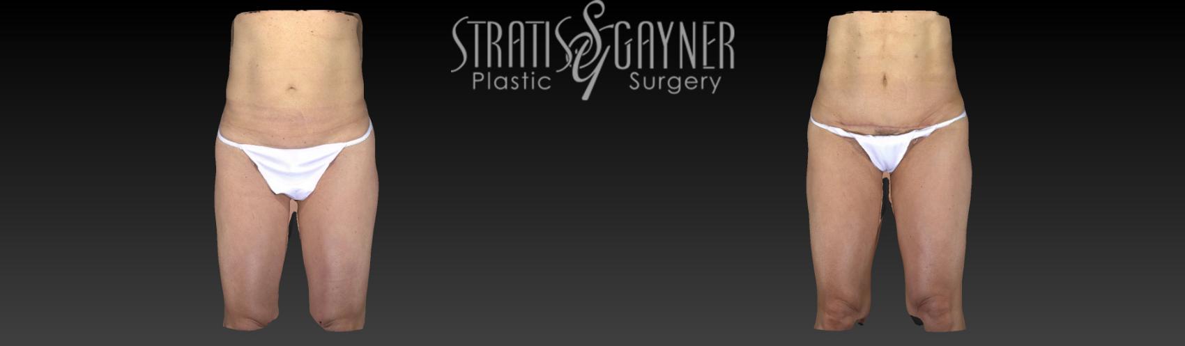 Tummy Tuck with Liposuction Case 155 Before & After View #1 | Harrisburg, PA | Stratis Gayner Plastic Surgery