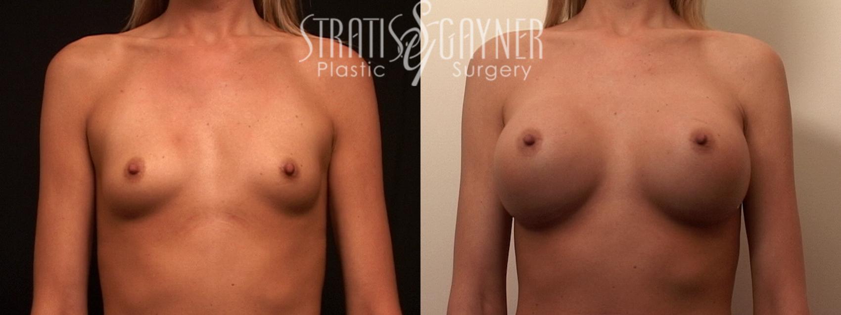 Before & After Breast Augmentation Case 82 View #1 View in Harrisburg, PA