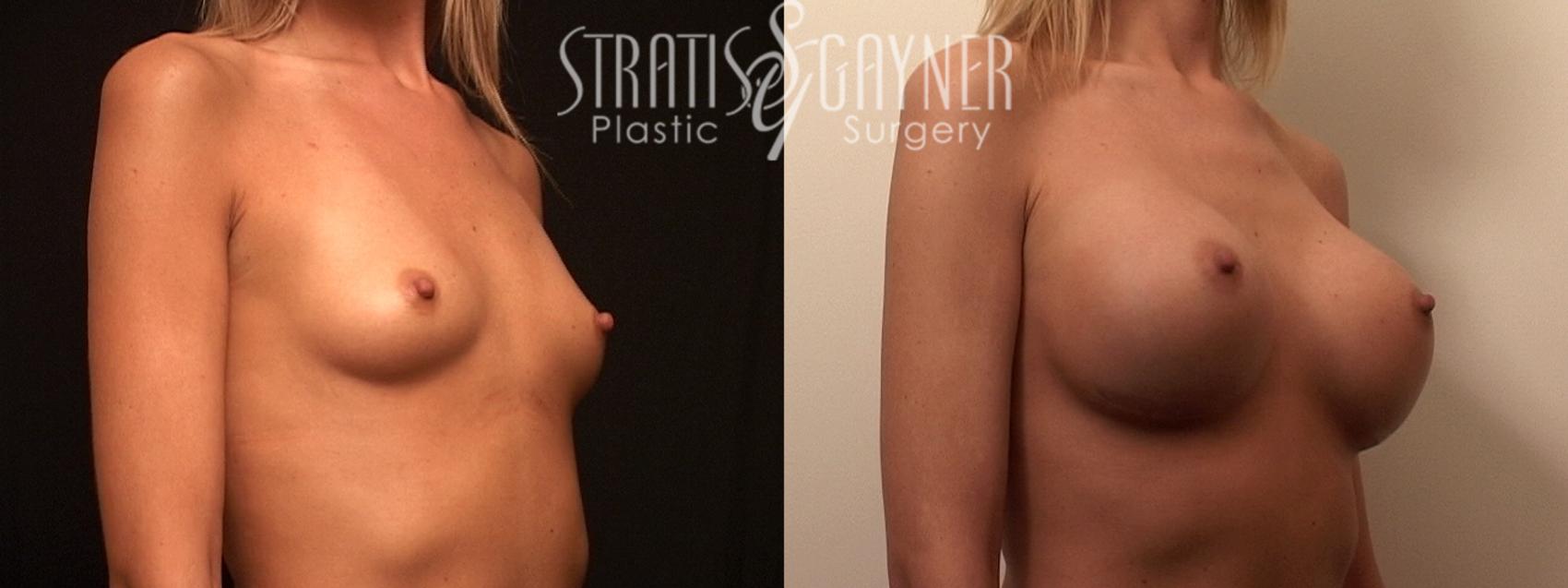 Before & After Breast Augmentation Case 82 View #4 View in Harrisburg, PA