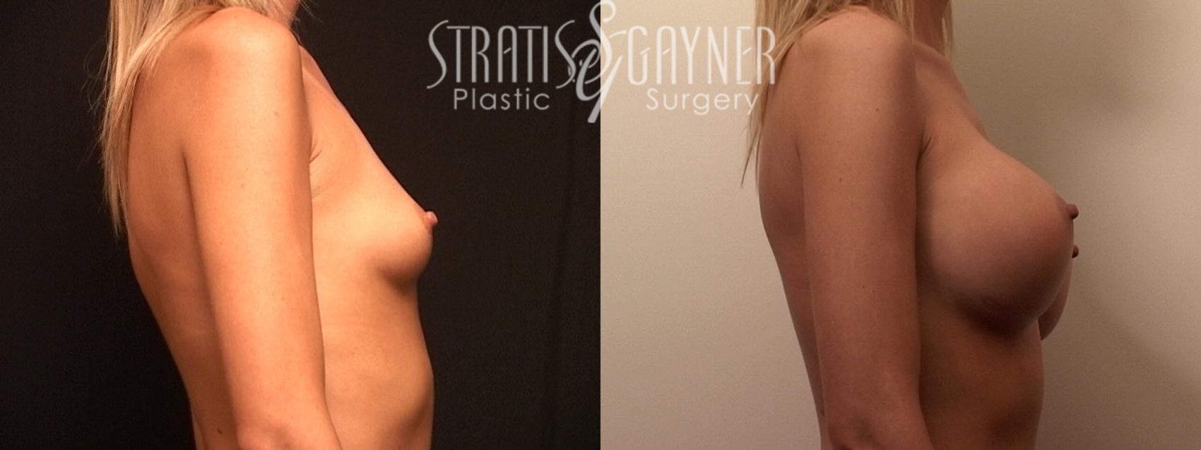 Before & After Breast Augmentation Case 82 View #5 View in Harrisburg, PA