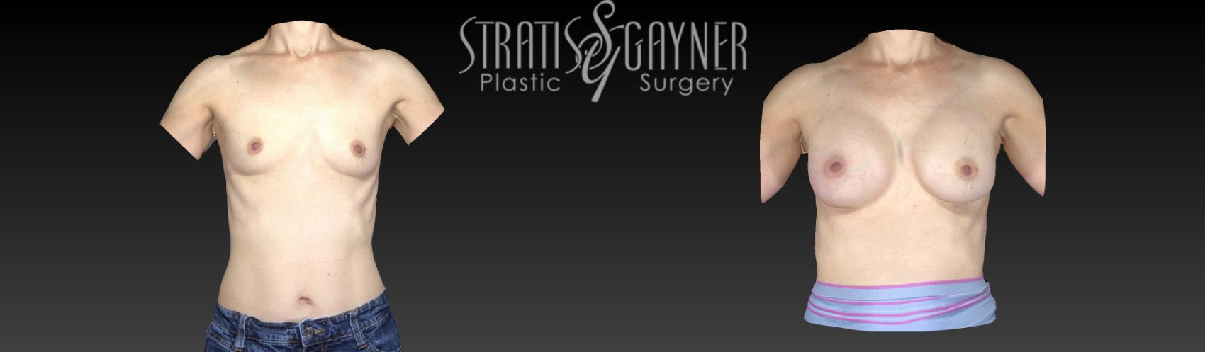 Before & After Breast Augmentation Case 85 View #1 View in Harrisburg, PA