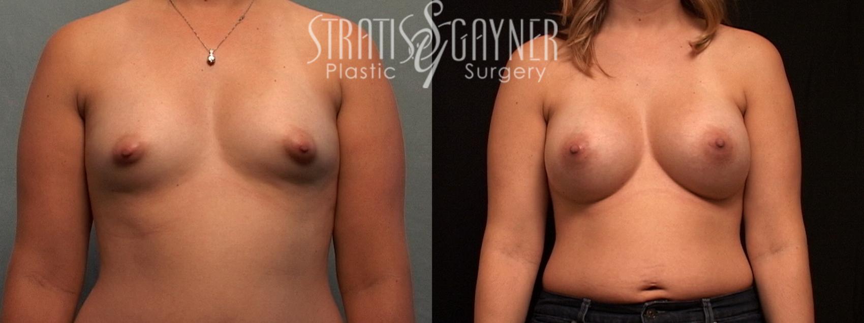 Before & After Breast Augmentation Case 95 View #1 View in Harrisburg, PA