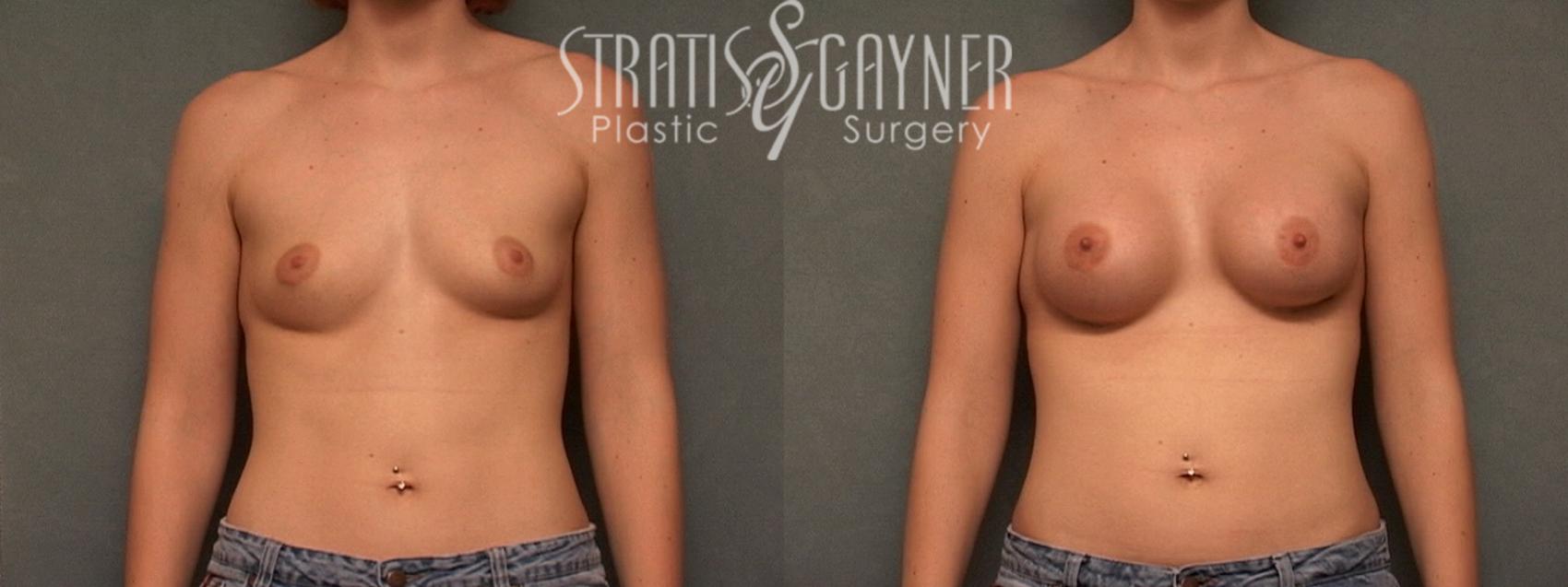 Before & After Breast Augmentation Case 96 View #1 View in Harrisburg, PA
