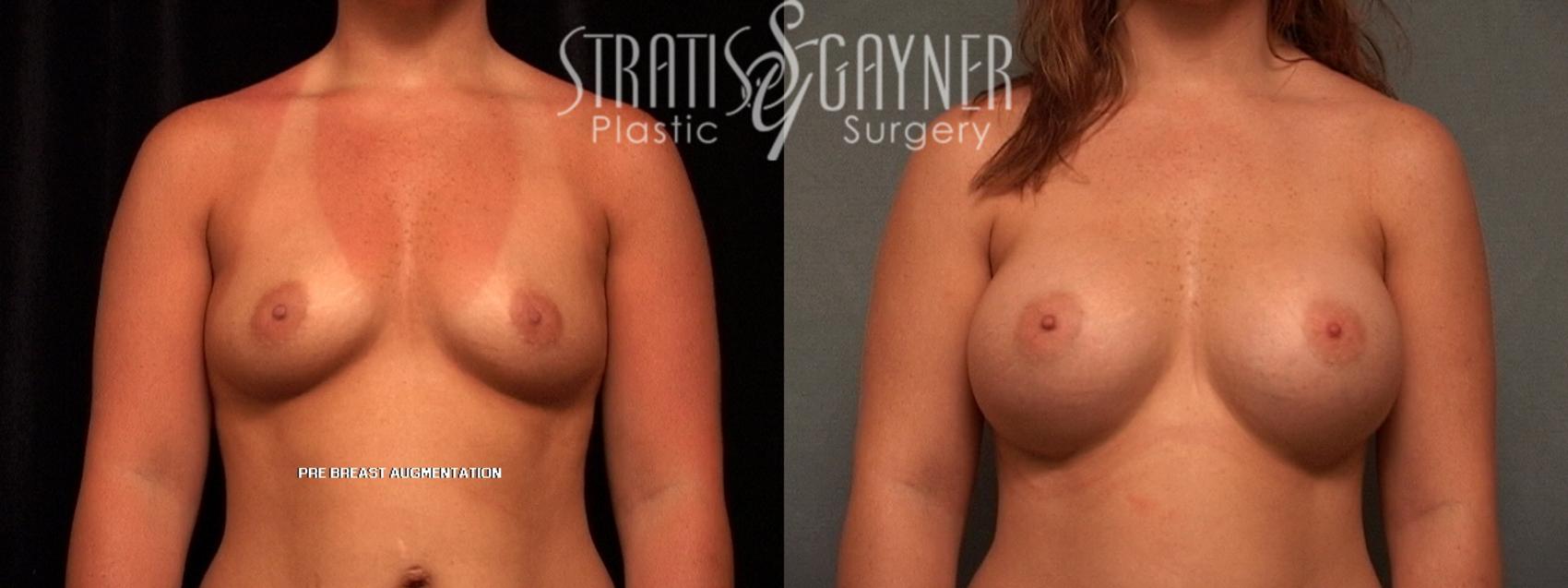 Before & After Breast Augmentation Case 99 View #1 View in Harrisburg, PA