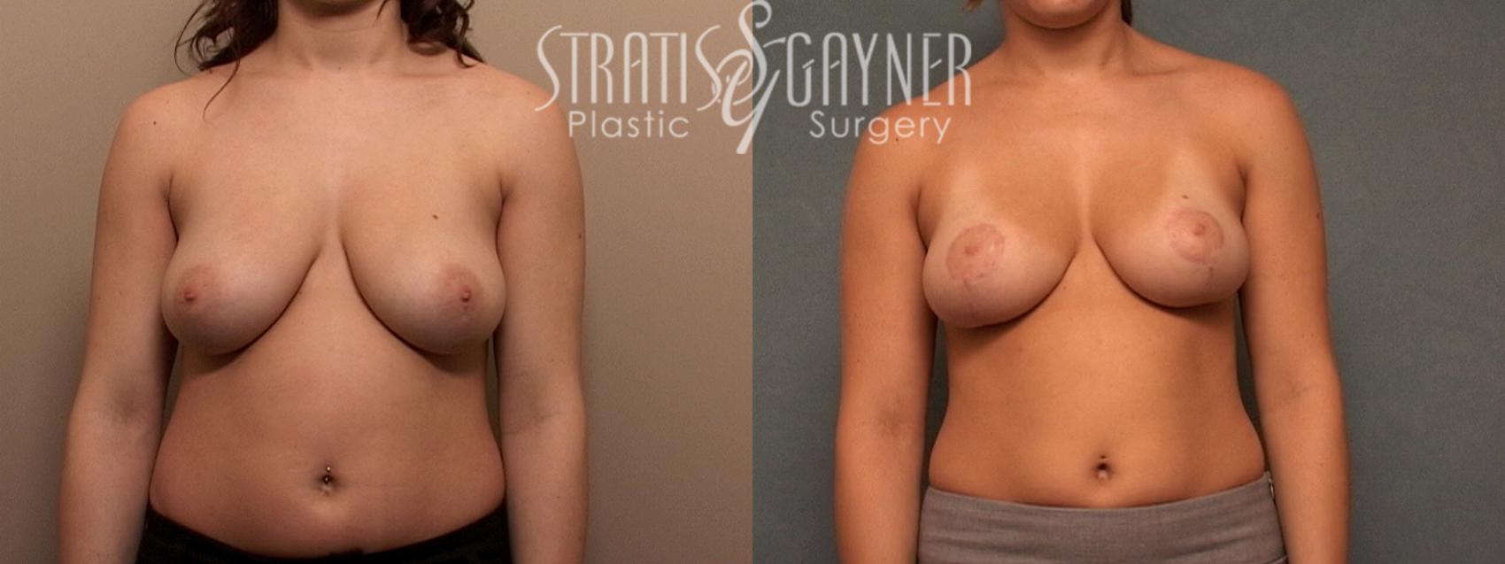 Before & After Breast Lift Case 56 View #1 View in Harrisburg, PA