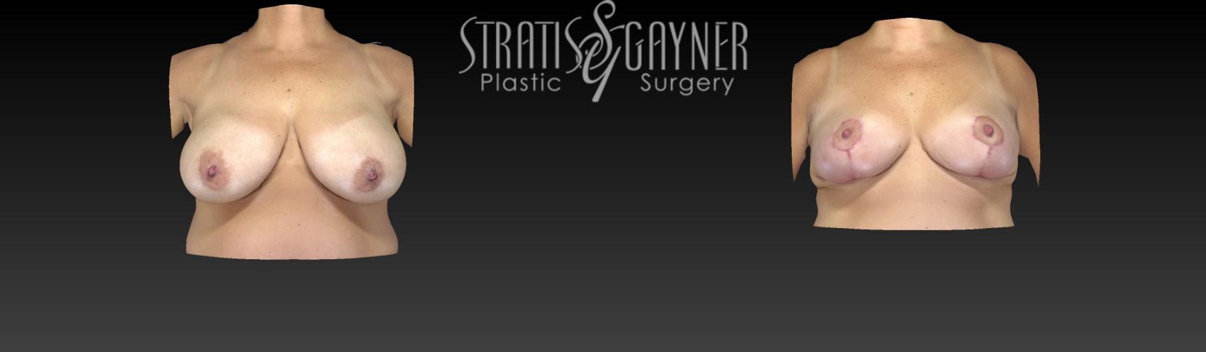 Before & After Breast Reduction Case 18 View #1 View in Harrisburg, PA