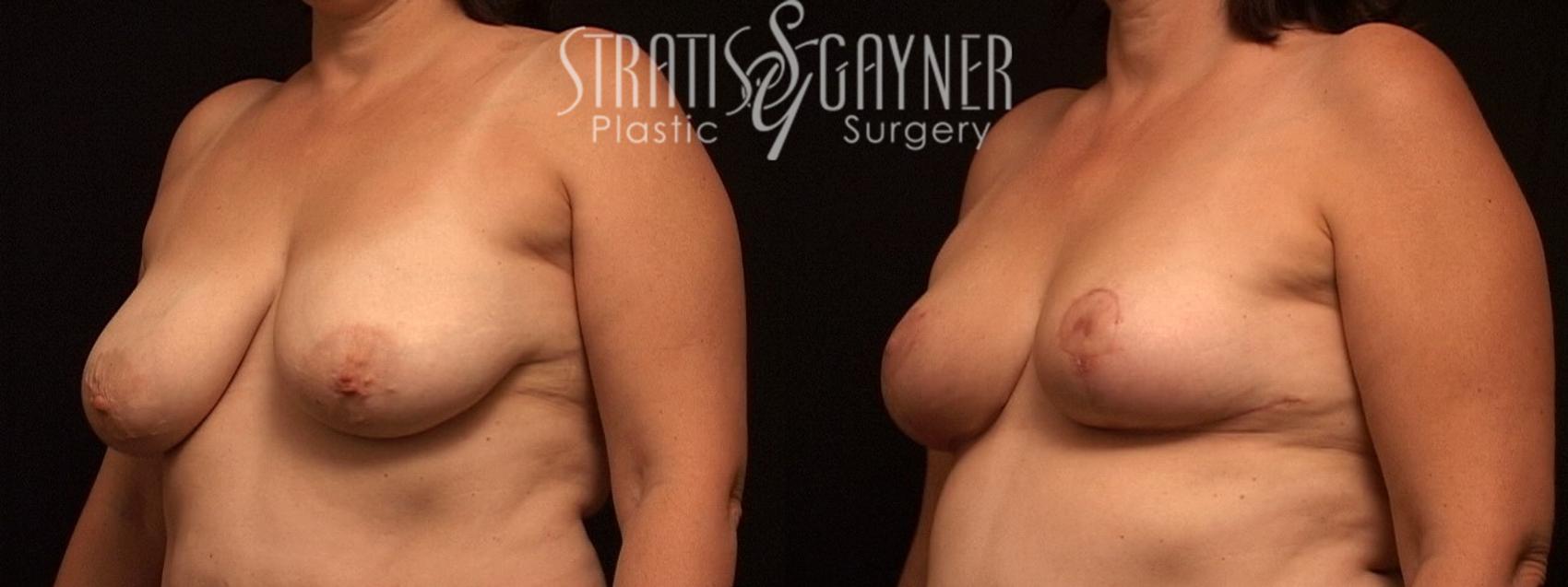 Before & After Breast Reduction Case 21 View #1 View in Harrisburg, PA