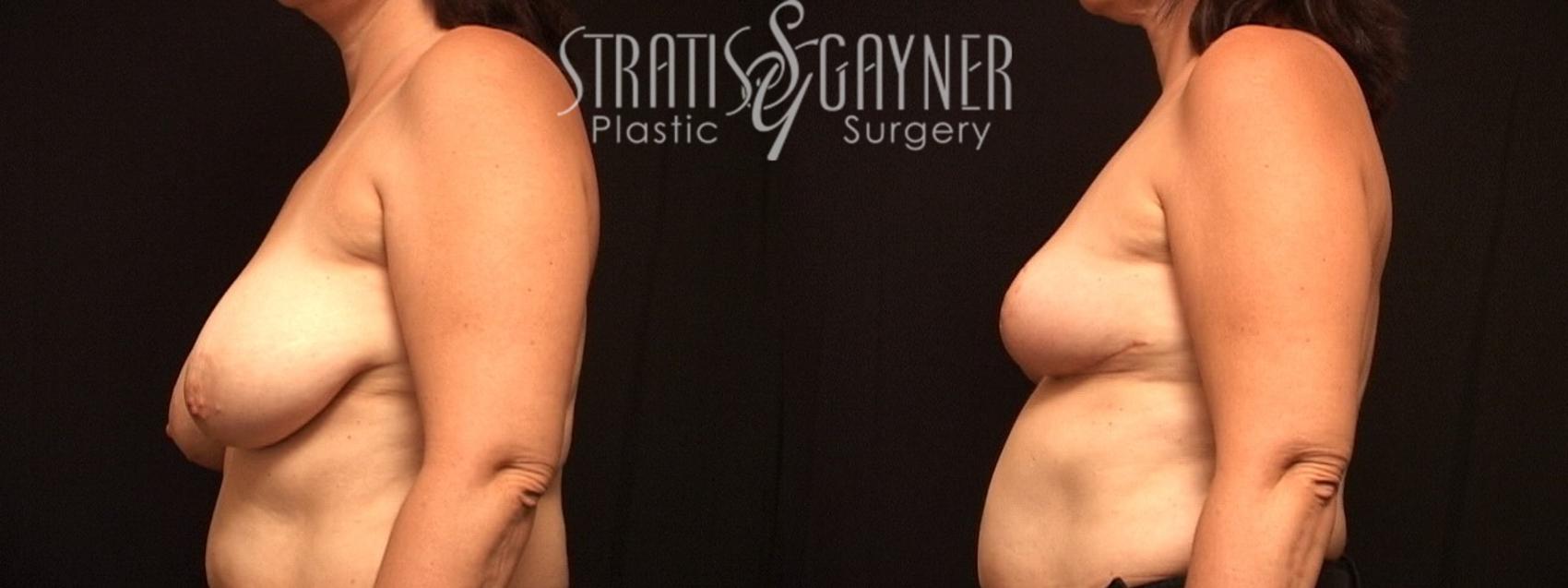 Before & After Breast Reduction Case 21 View #2 View in Harrisburg, PA