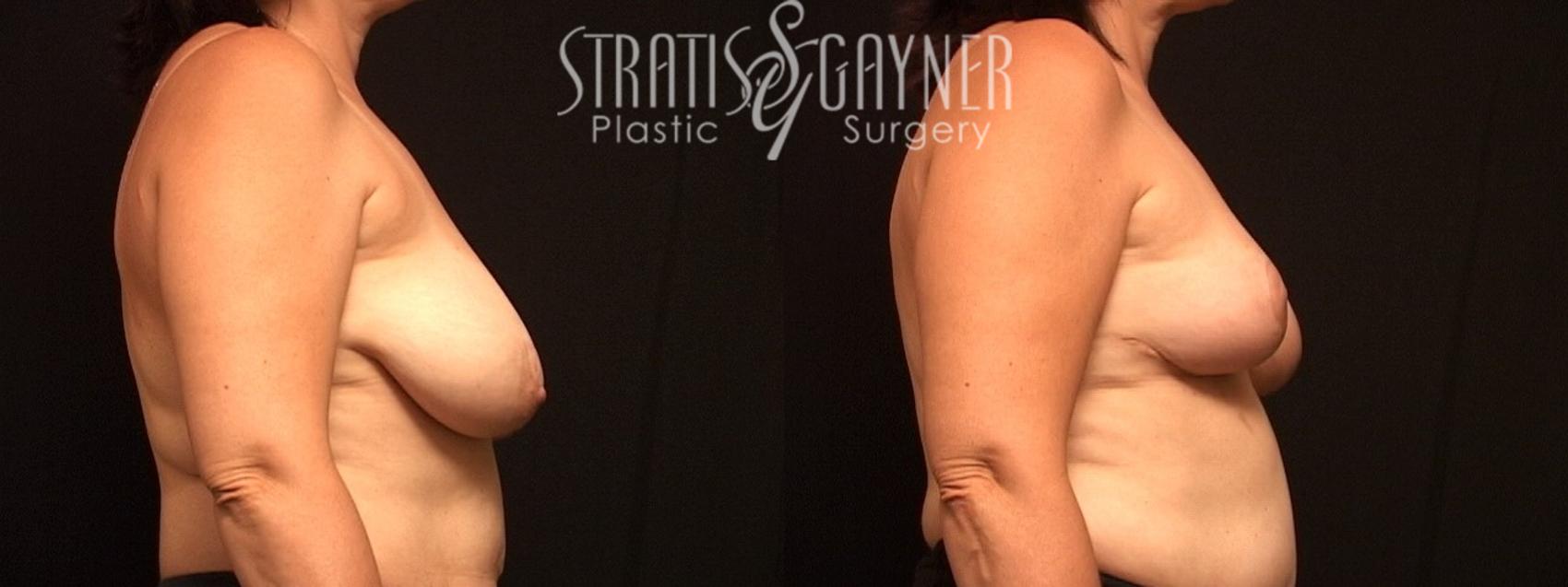 Before & After Breast Reduction Case 21 View #4 View in Harrisburg, PA