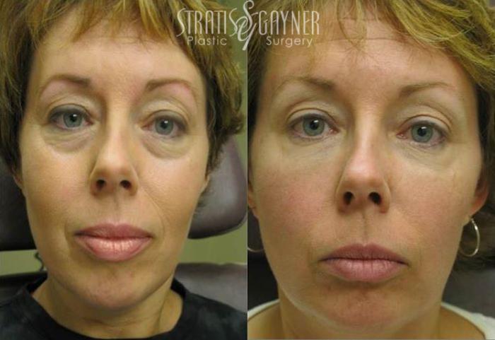 Before & After Dermal Fillers Case 180 View #1 View in Harrisburg, PA