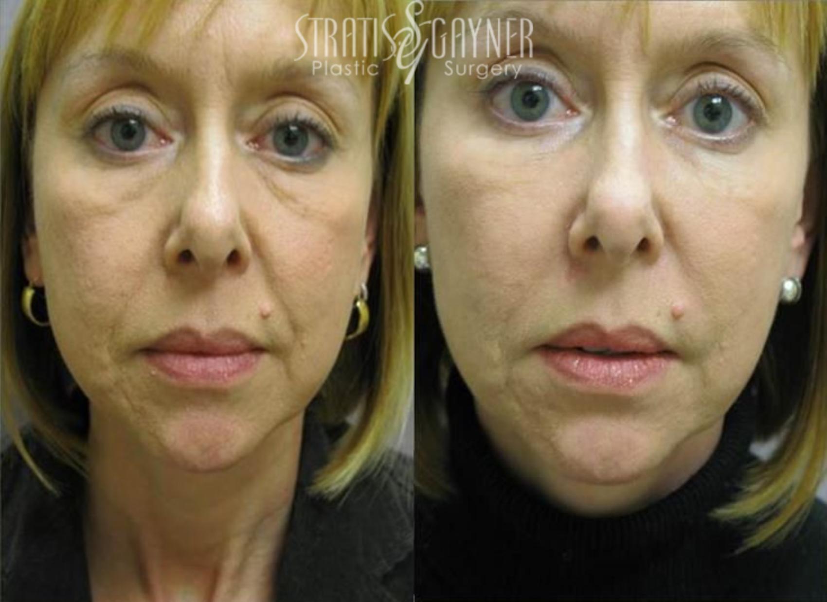 Before & After Dermal Fillers Case 181 View #1 View in Harrisburg, PA