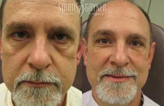 Before & After Dermal Fillers Case 183 View #1 View in Harrisburg, PA