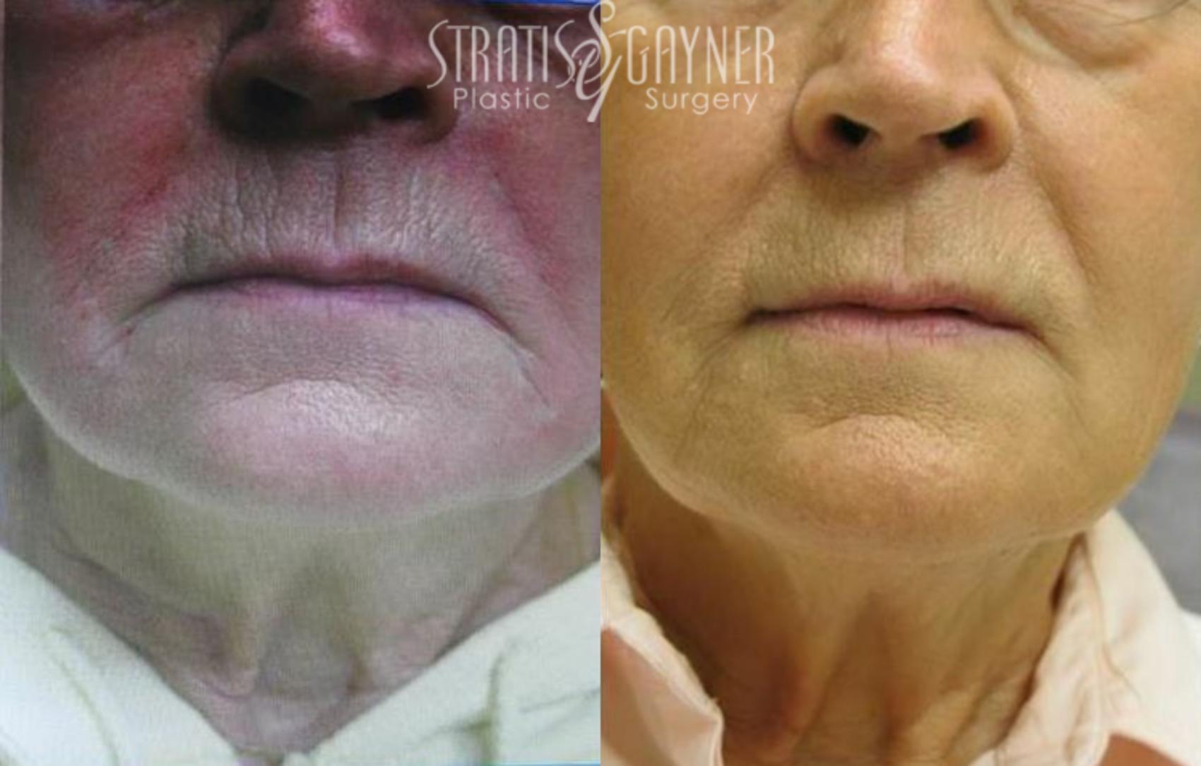 Before & After Dermal Fillers Case 184 View #1 View in Harrisburg, PA